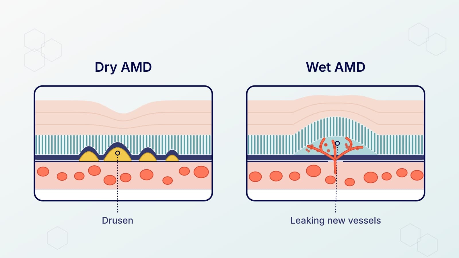 Illustration of the back of the eye in cross-section. In dry AMD, yellow deposits called drusen build up under the retina. In wet AMD, abnormal new blood vessels grow up from below and leak fluid under the retina, lifting it.